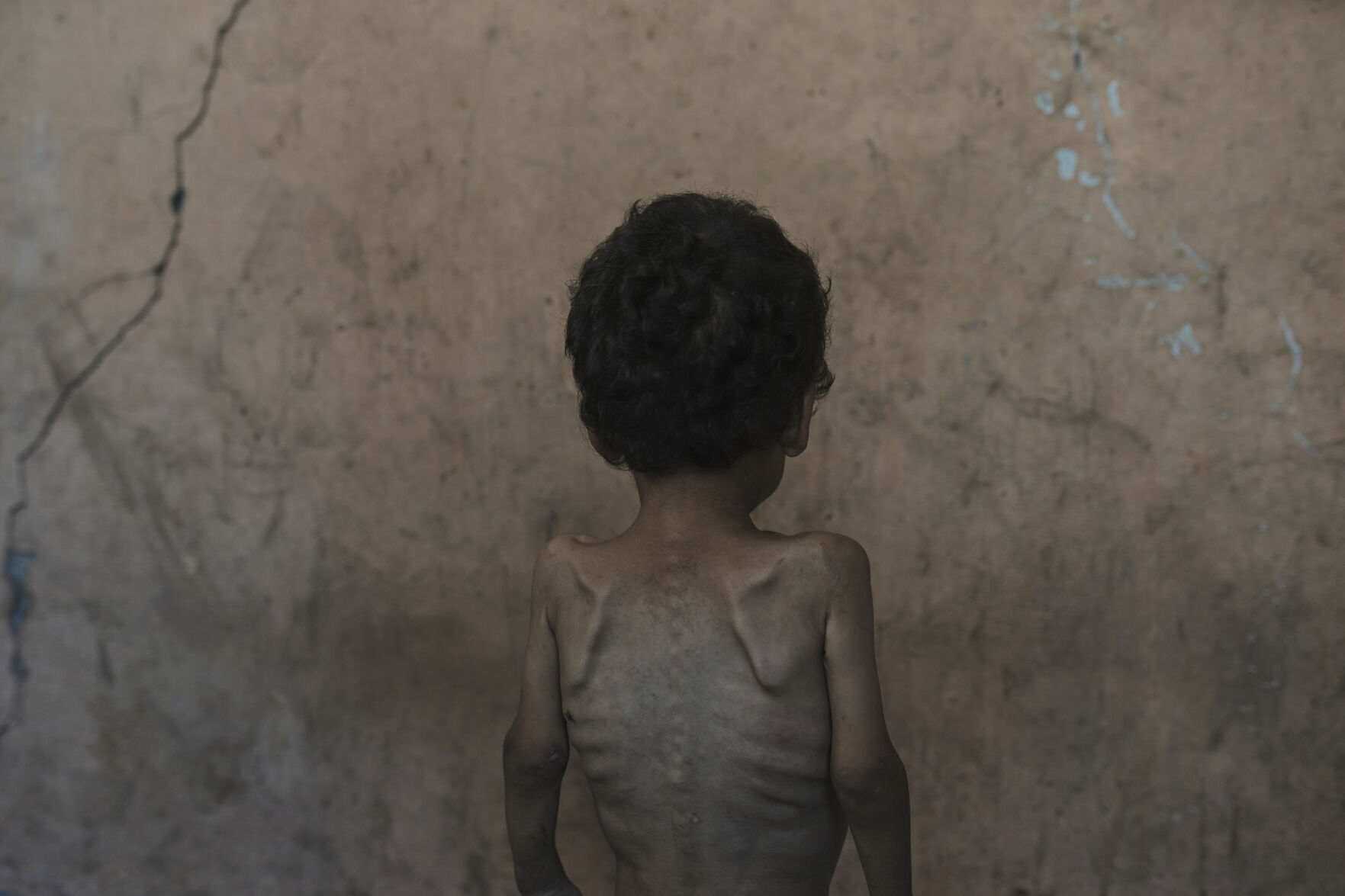 APTOPIX Mideast Wars Dying of Hunger
